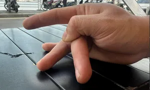 Bẻ ngón tay thư giãn có gây trật khớp?