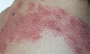Cách nào ngăn đau thần kinh sau zona kéo dài? Cách nào ngăn đau thần kinh sau zona kéo dài?