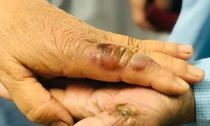 Hai vợ chồng bị chuột cắn nhiễm độc Hai vợ chồng bị chuột cắn nhiễm độc