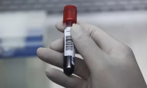 Hơn 44% người Việt trưởng thành có cholesterol máu cao Hơn 44% người Việt trưởng thành có cholesterol máu cao
